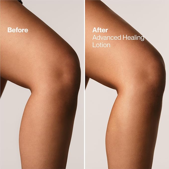 Suave+ Advanced Healing Hand & Body Lotion for Women With Ceramides for Very Dry Skin, Hydrating, Non-Greasy, Allergen-Free Moisturizing Cream, Lightly Scented, 18 FL OZ, 6 Pack-FemmiqueWomen