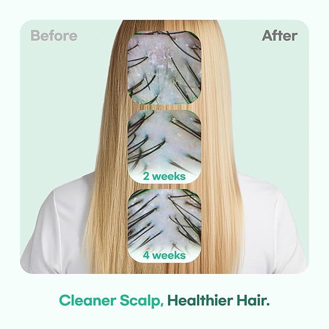 TS GD Shampoo for Teens | Korean Anti-Dandruff Shampoo for Oily & Itchy Scalp | Fruity Allergy-Free Scent | Sulfate-Free Gentle Hair Care (14.1 Oz)-FemmiqueWomen