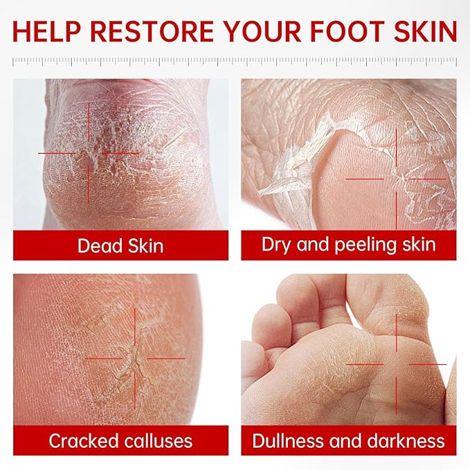 3 Pack Foot Peeling Mask, Hydrating Exfoliating Foot Mask for Dry Cracked Feet, Callus Remover & Cracked Heel Repair & Foot Care-FemmiqueWomen