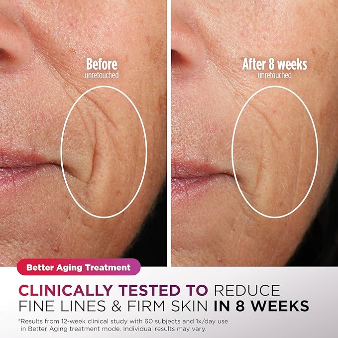 Shark CryoGlow LED Face Mask with Under-Eye Cooling, Anti-Ageing & Blemish Repair, Red & Blue LED, Infrared Light Therapy, USB-C, Remote Control, Storage Bag, Lilac Chill, FW312PL